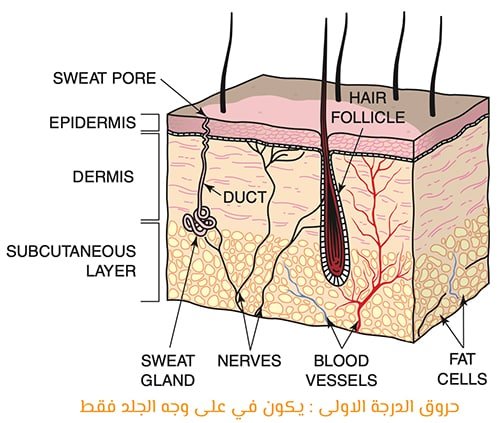 الحروق من الدرجة الأولى